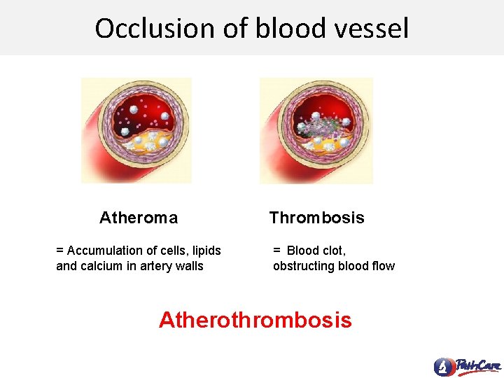 Occlusion of blood vessel Atheroma = Accumulation of cells, lipids and calcium in artery