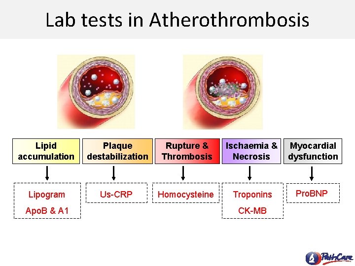 Lab tests in Atherothrombosis Lipid accumulation Plaque destabilization Rupture & Thrombosis Ischaemia & Necrosis