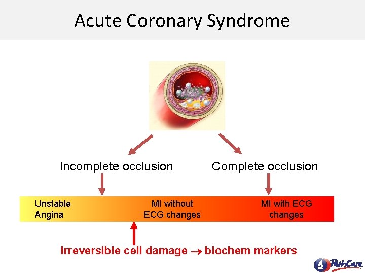 Acute Coronary Syndrome Incomplete occlusion Unstable Angina MI without ECG changes Complete occlusion MI