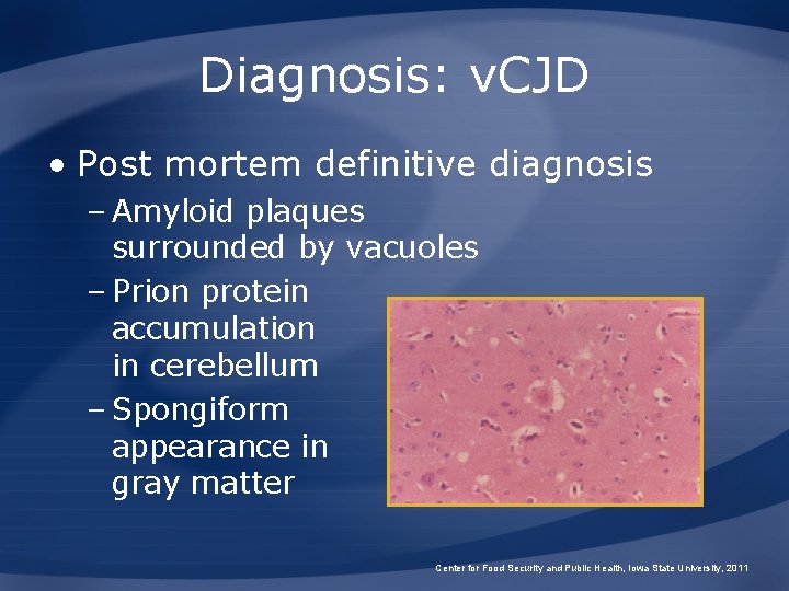 Diagnosis: v. CJD • Post mortem definitive diagnosis – Amyloid plaques surrounded by vacuoles