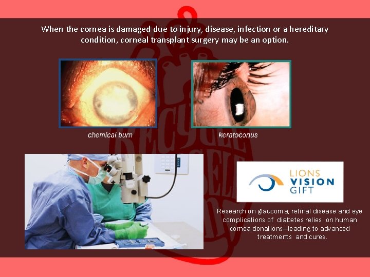When the cornea is damaged due to injury, disease, infection or a hereditary condition,