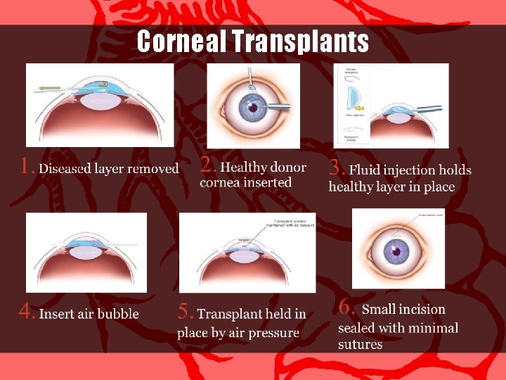 Corneal Transplants 