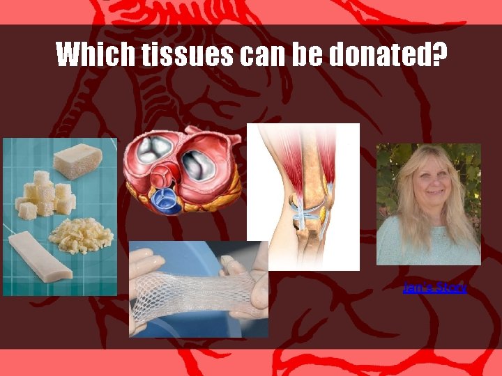 Which tissues can be donated? Jan’s Story 