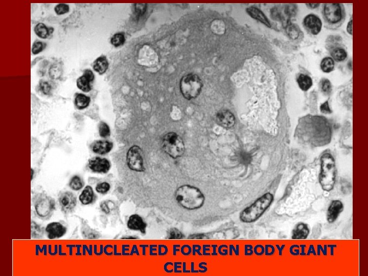 MULTINUCLEATED FOREIGN BODY GIANT CELLS 