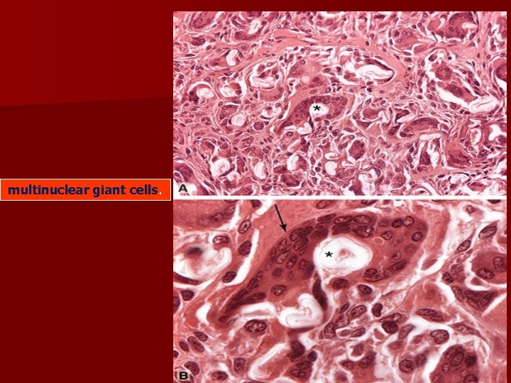 multinuclear giant cells multinuclear giant cells