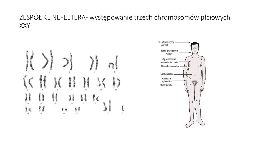 ZESPÓŁ KLINEFELTERA- występowanie trzech chromosomów płciowych XXY 