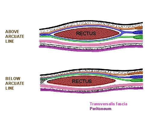 ABOVE ARCUATE LINE BELOW ARCUATE LINE RECTUS Transversalis fascia Peritoneum 