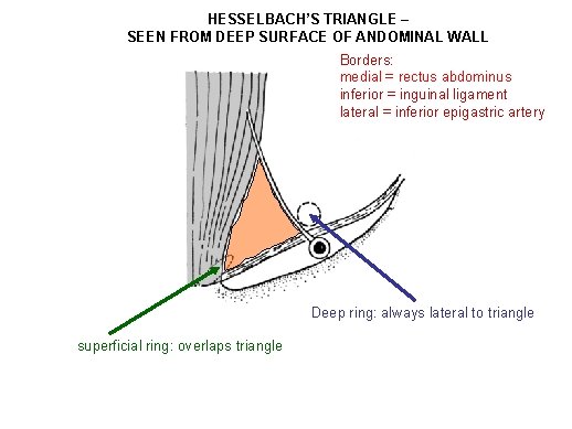 HESSELBACH’S TRIANGLE – SEEN FROM DEEP SURFACE OF ANDOMINAL WALL Borders: medial = rectus