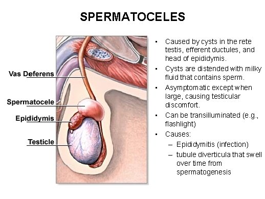 SPERMATOCELES • Caused by cysts in the rete testis, efferent ductules, and head of