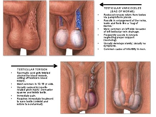  • • • TESTICULAR TORSION Spermatic cord gets twisted around the blood vessels,