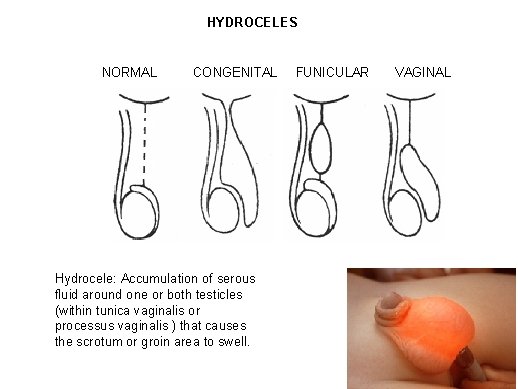 HYDROCELES NORMAL CONGENITAL Hydrocele: Accumulation of serous fluid around one or both testicles (within