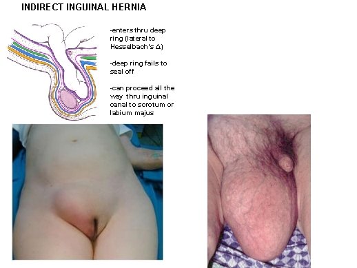 INDIRECT INGUINAL HERNIA -enters thru deep ring (lateral to Hesselbach’s Δ) -deep ring fails