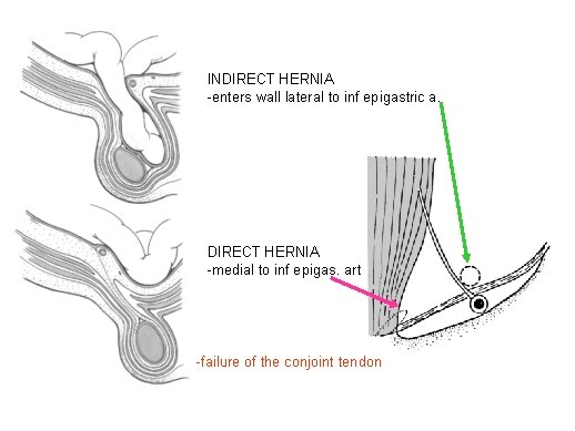 INDIRECT HERNIA -enters wall lateral to inf epigastric a. DIRECT HERNIA -medial to inf