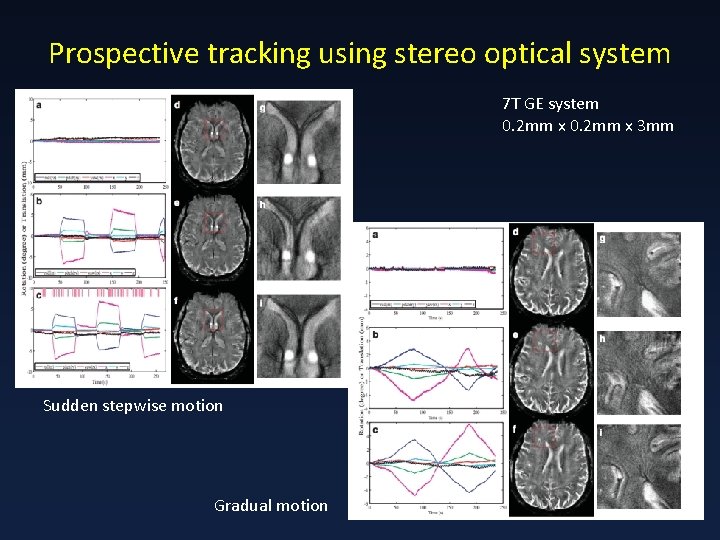 Prospective tracking using stereo optical system 7 T GE system 0. 2 mm x