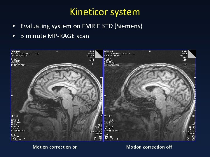 Kineticor system • Evaluating system on FMRIF 3 TD (Siemens) • 3 minute MP-RAGE