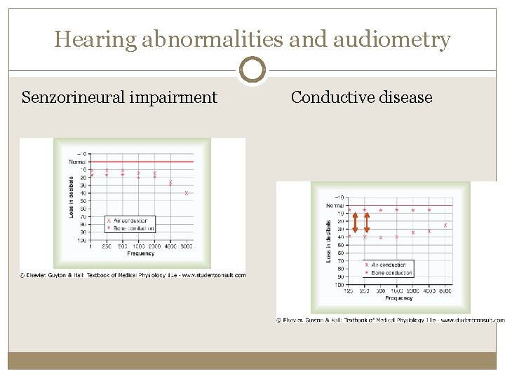 Hearing abnormalities and audiometry Senzorineural impairment Conductive disease 