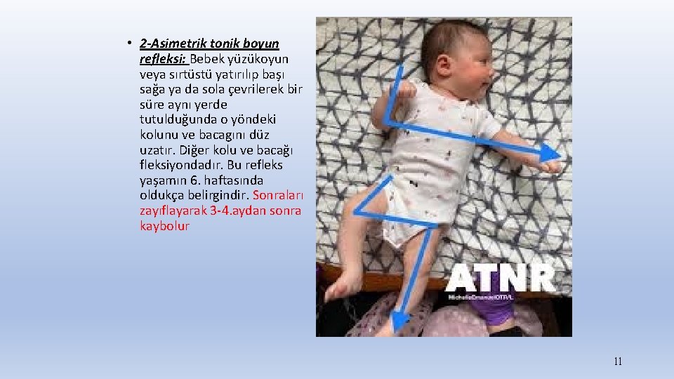  • 2 -Asimetrik tonik boyun refleksi: Bebek yüzükoyun veya sırtüstü yatırılıp başı sağa