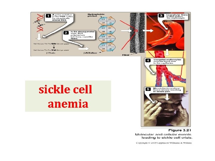 sickle cell anemia 