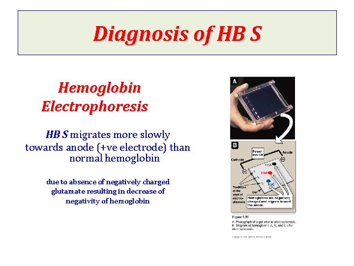 Diagnosis of HB S Hemoglobin Electrophoresis HB S migrates more slowly towards anode (+ve