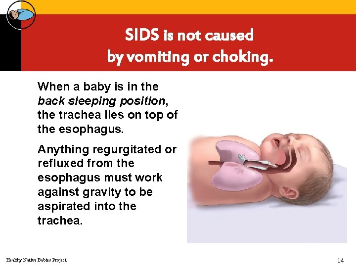 SIDS is not caused by vomiting or choking. When a baby is in the