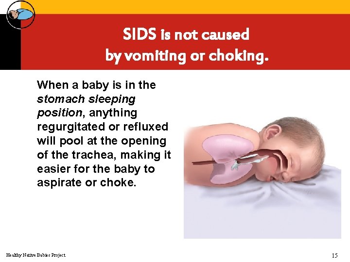SIDS is not caused by vomiting or choking. When a baby is in the