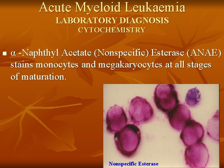 Acute Myeloid Leukaemia LABORATORY DIAGNOSIS CYTOCHEMISTRY n α -Naphthyl Acetate (Nonspecific) Esterase (ANAE) stains