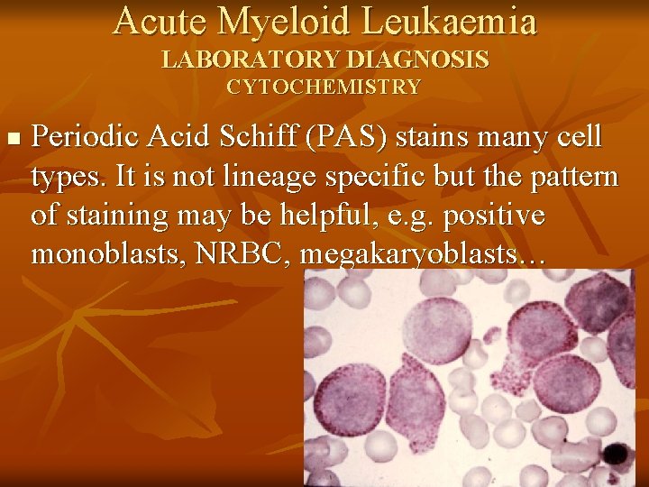 Acute Myeloid Leukaemia LABORATORY DIAGNOSIS CYTOCHEMISTRY n Periodic Acid Schiff (PAS) stains many cell