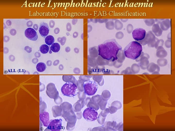 Acute Lymphoblastic Leukaemia Laboratory Diagnosis - FAB Classification ALL (L 1) ALL (L 2)