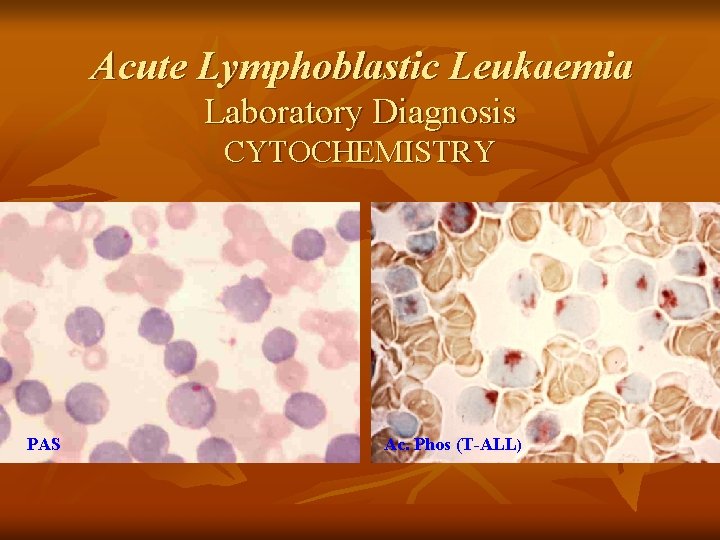 Acute Lymphoblastic Leukaemia Laboratory Diagnosis CYTOCHEMISTRY PAS Ac. Phos (T-ALL) 