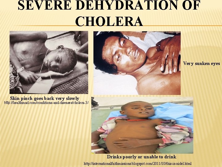 SEVERE DEHYDRATION OF CHOLERA Very sunken eyes Skin pinch goes back very slowly http: