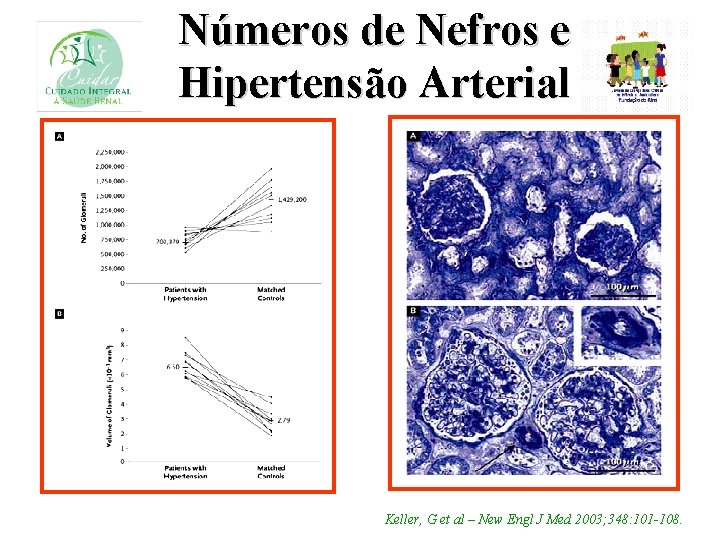 Números de Nefros e Hipertensão Arterial Keller, G et al – New Engl J