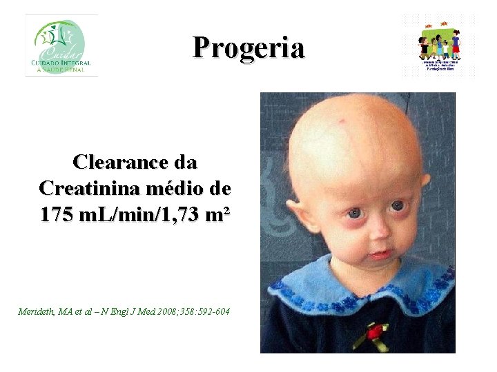 Progeria Clearance da Creatinina médio de 175 m. L/min/1, 73 m² Merideth, MA et