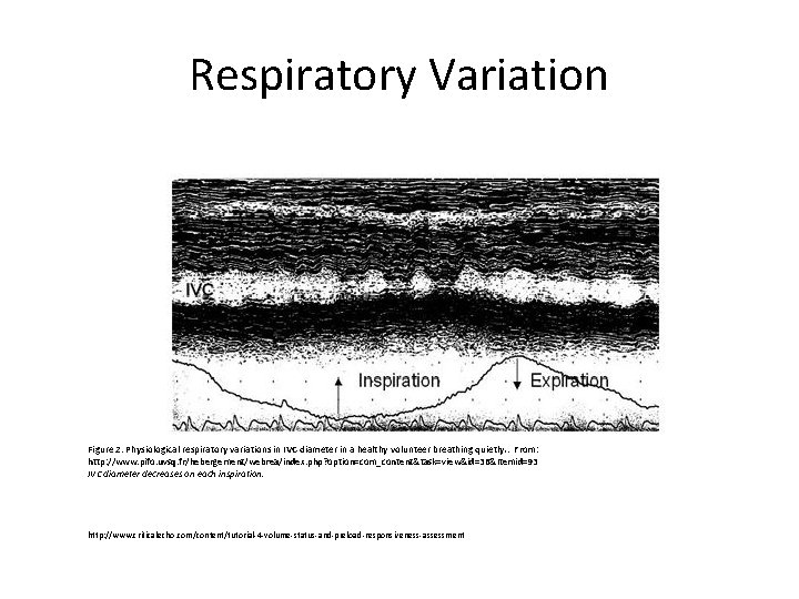 Respiratory Variation Figure 2: Physiological respiratory variations in IVC diameter in a healthy volunteer