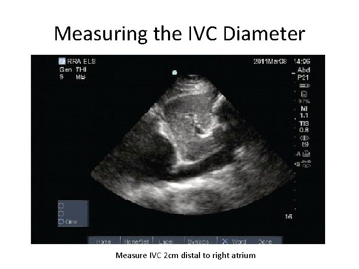 Measuring the IVC Diameter Measure IVC 2 cm distal to right atrium 