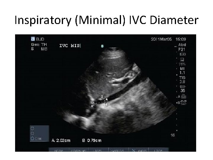 Inspiratory (Minimal) IVC Diameter 