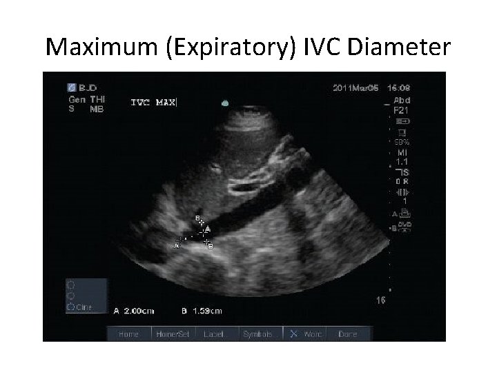 Maximum (Expiratory) IVC Diameter 