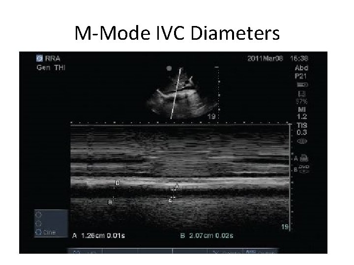 M-Mode IVC Diameters 