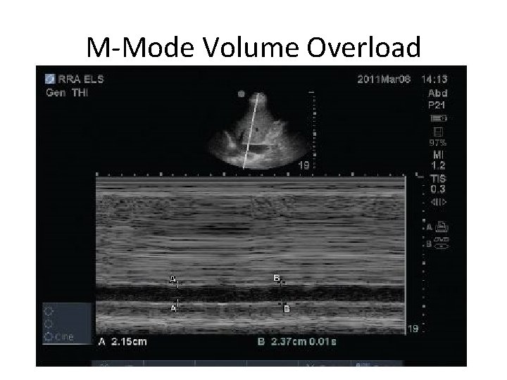 M-Mode Volume Overload 