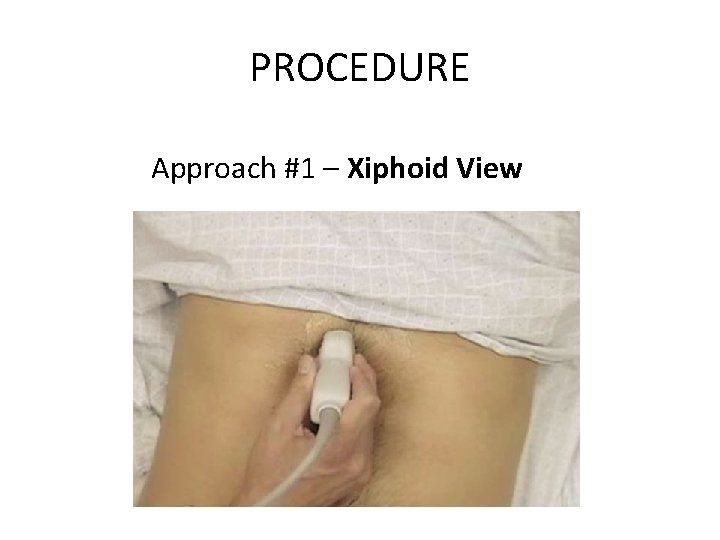 PROCEDURE Approach #1 – Xiphoid View 