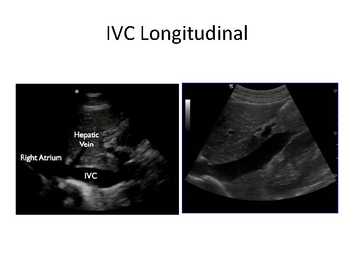 IVC Longitudinal 