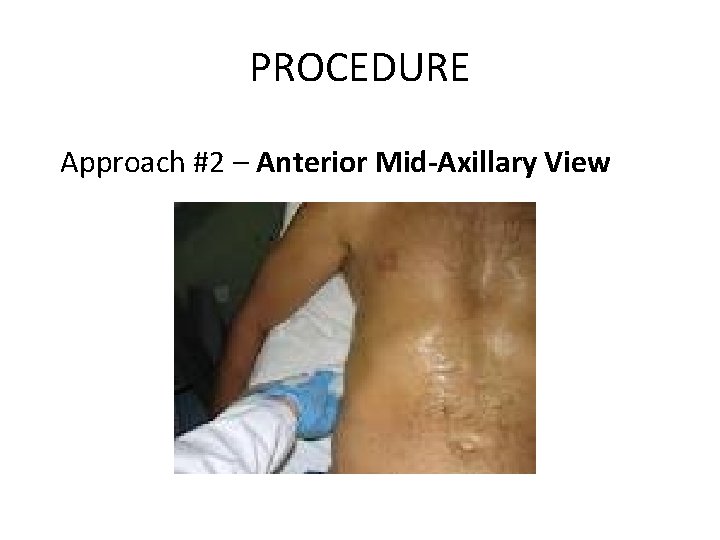 PROCEDURE Approach #2 – Anterior Mid-Axillary View 