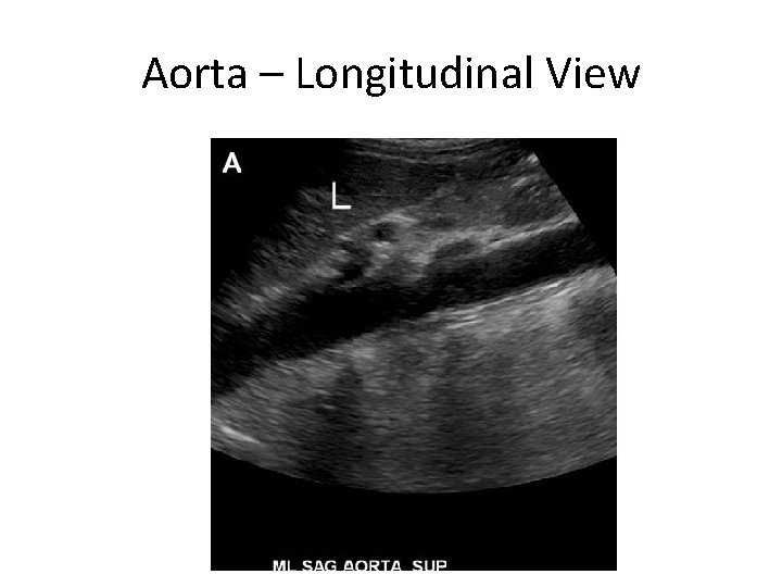 Aorta – Longitudinal View 