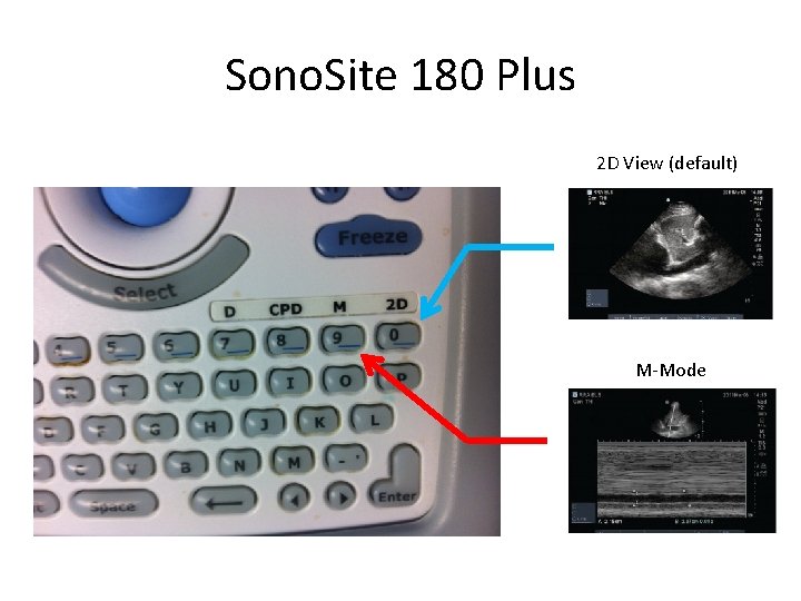 Sono. Site 180 Plus 2 D View (default) M-Mode 