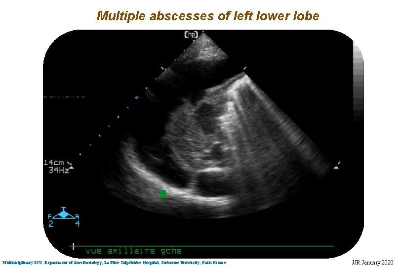 Multiple abscesses of left lower lobe Multisiciplinary ICU, Department of Anesthesiology, La Pitié-Salpêtrière Hospital,