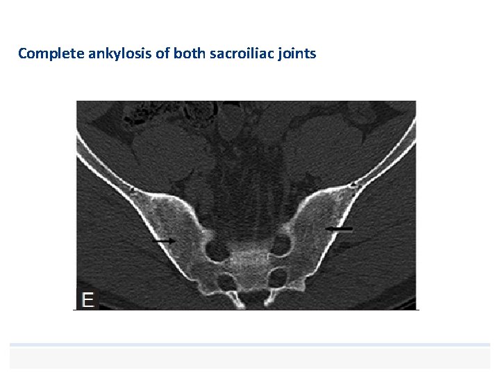 Complete ankylosis of both sacroiliac joints 