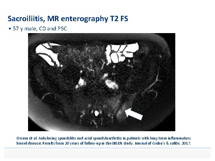 Sacroiliitis, MR enterography T 2 FS • 57 y male, CD and PSC Ossum