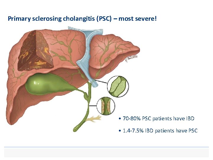 Primary sclerosing cholangitis (PSC) – most severe! • 70 -80% PSC patients have IBD