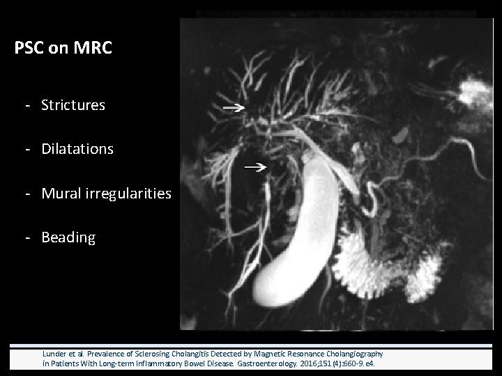 PSC on MRC - Strictures - Dilatations - Mural irregularities - Beading Lunder et