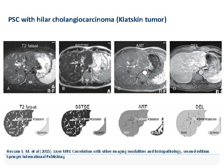 PSC with hilar cholangiocarcinoma (Klatskin tumor) Hussain S. M. et al (2015). Liver MRI: