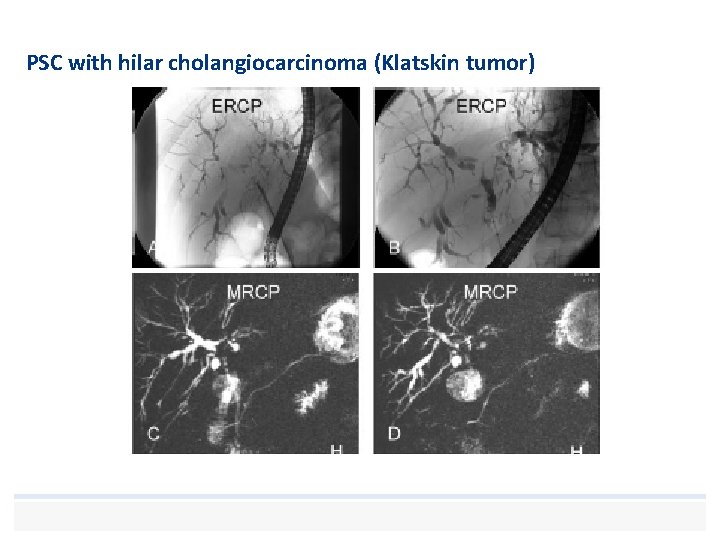 PSC with hilar cholangiocarcinoma (Klatskin tumor) 